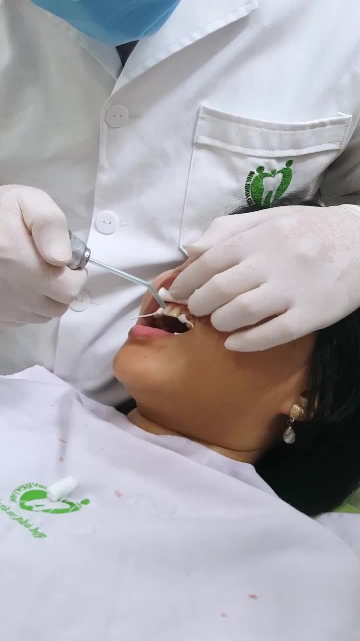 QUÁ TRÌNH DÁN SỨ VENEER CAO CẤP CHO NỮ KHÁCH HÀNG XINH ĐẸP